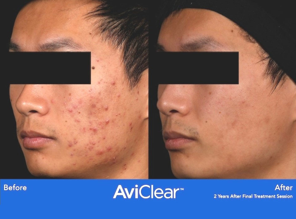 aviclear laser after & before